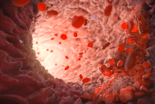 血管内のイメージ画像